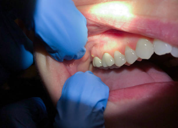 Best Tooth Infection Emergency Dentist  in Woodsfield, OH